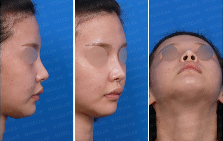 Side and nostril views before High Radix Rhinoplasty Korea showing upturned tip.