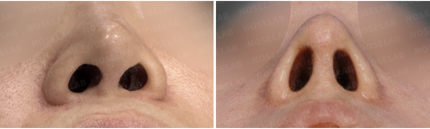 Nostril view before and immediately after autologous rib cartilage revision rhinoplasty