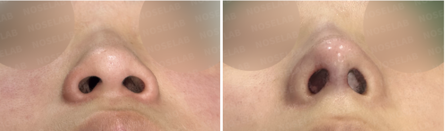 Before and immediately after surgery basal view showing improved nostril symmetry, reduced nasal tip drooping, and refined nasal base following closed rhinoplasty with rib cartilage reconstruction and osteotomy.