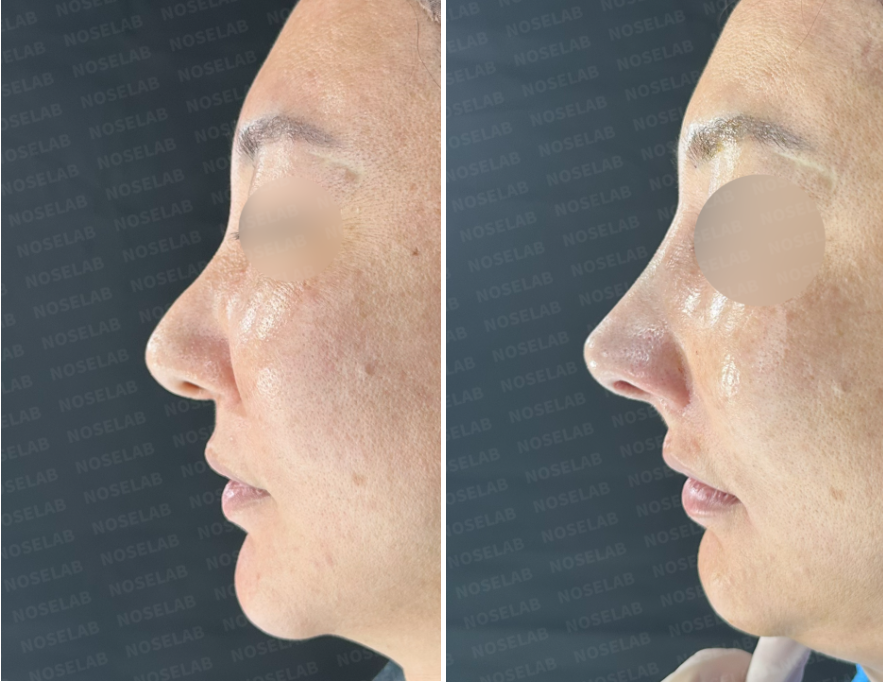 Left side view before and immediately after revision rhinoplasty using rib cartilage graft to correct a crooked nasal bridge and drooping tip. Results show lifted tip and smoother nasal profile.