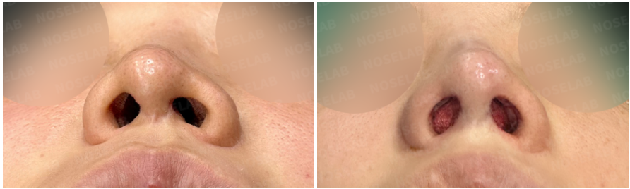 Before and after crooked nose correction – nostril view showing improved symmetry and open nasal passages after septal reconstruction.