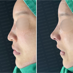 Crooked nose correction and nasal obstruction improvement using autologous rib cartilage – side view before and after surgery.