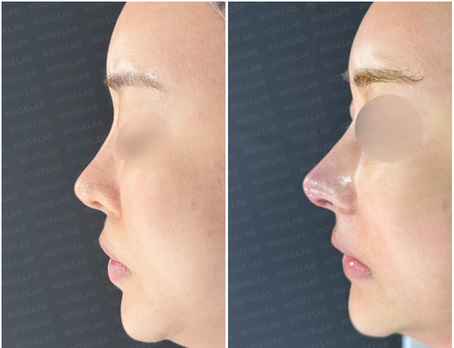 Before and immediately after Upturned Nose Correction – side profile view showing elevated nasal tip and improved nasal bridge contour.