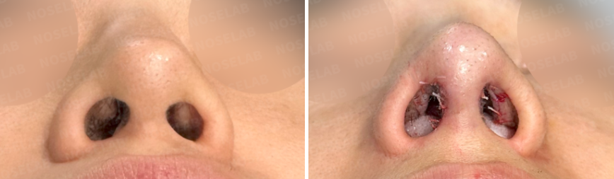 Before (left) and immediately after surgery (right) nostril view photos of a male patient, showing correction of nostril asymmetry and improved columella alignmen