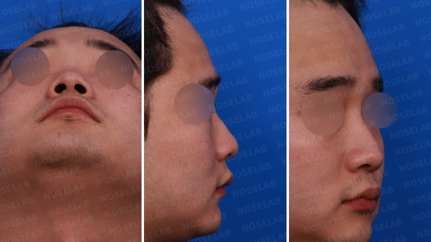 Pre-surgery design consultation – nostril, left side, and oblique side views of a short and wide male nose before Male Rhinoplasty Korea with closed rhinoplasty, showing nostril asymmetry, low nasion, and broad nasal tip.