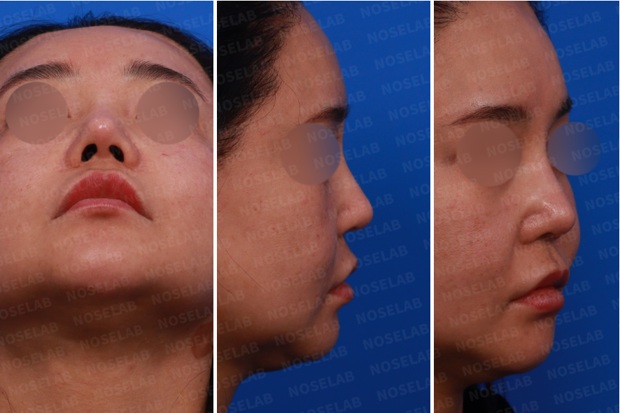 Nostril, right side, and oblique side view photos before nasal septum reconstruction surgery