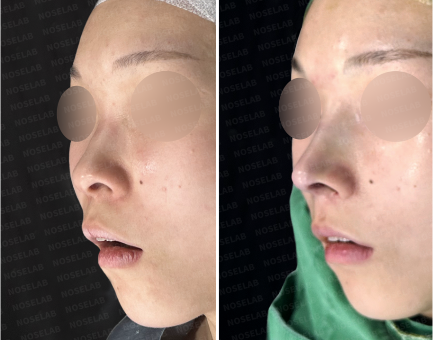 Before and immediately after surgery oblique view showing a smoother nasal bridge line and refined nasal tip contour following closed rhinoplasty using donor rib cartilage and a silicone implant.