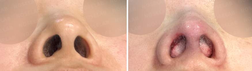 Nostril view of upturned nose correction – Before surgery (left) and immediately after closed rhinoplasty (right), showing nostril asymmetry and columella adjustment.