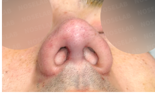 Immediately after surgery – nostril view of male patient showing improved columella alignment and nostril symmetry.
