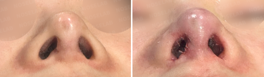 Before and after comparison – nostril view of a patient before surgery (left) and immediate results after Revision Rhinoplasty Korea with closed approach (right), showing improved nostril symmetry, corrected columella scars, and restored nasal tip skin.