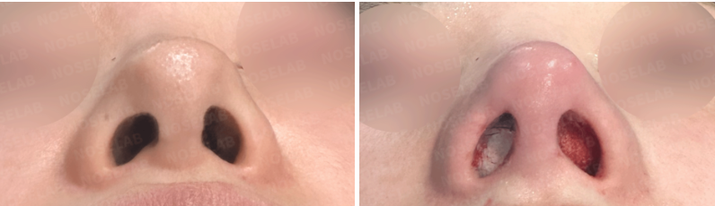 Before and immediately after no-implant nose surgery using autologous rib cartilage: Nostril view showing improved nostril symmetry and surgical correction.