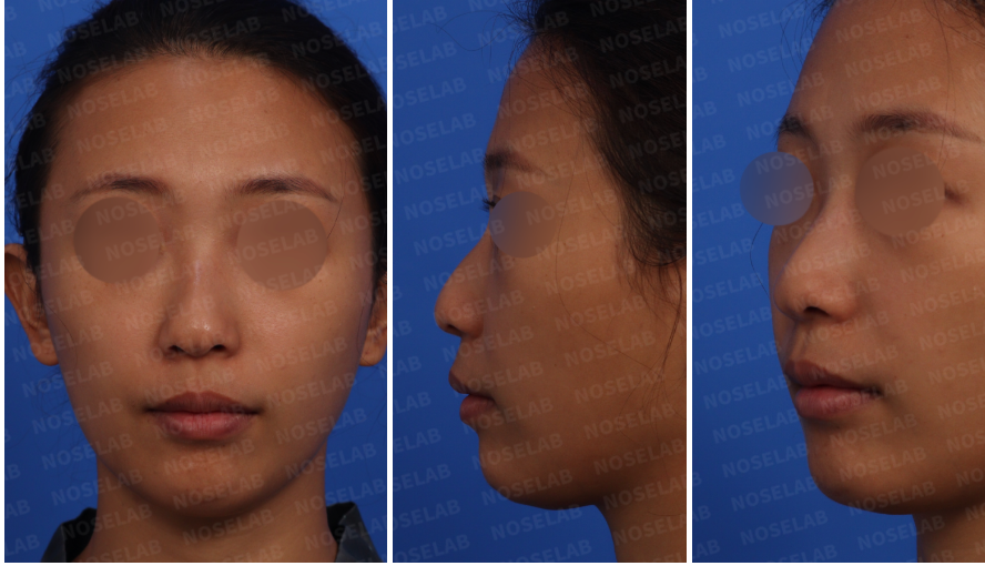 Pre-surgery design consultation photos for split nasal tip correction: frontal view, left side view, and oblique side view.