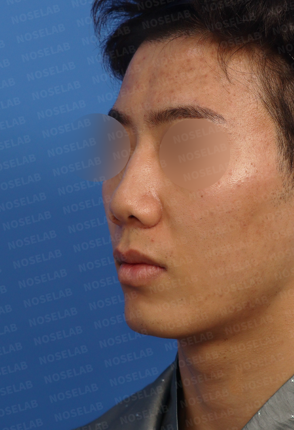 45-degree oblique view of Asian male patient before Closed Rhinoplasty Korea, showing bumpy nasal bridge, blunt tip, and asymmetry.
