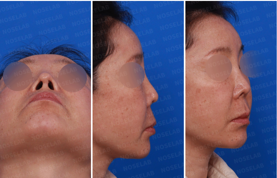 Preoperative consultation images for upturned nose correction, featuring nostril view, right-side view, and oblique view highlighting columella retraction and nostril asymmetry.