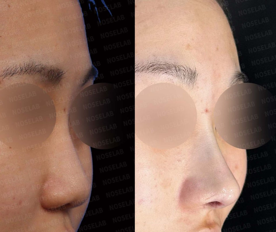 Before and after right 45-degree photos showing balanced nasal contour and correction of a deviated small nose after Closed Rhinoplasty Korea.