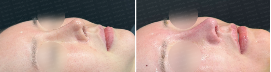 Before and immediately after revision rhinoplasty: oblique side view comparison showing nasal line improvement and profile balance.