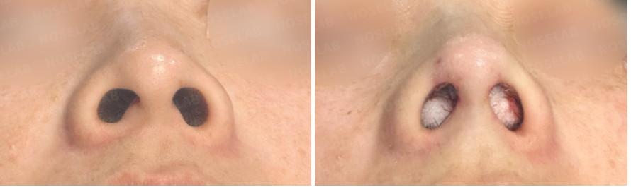 Before and immediately after primary rhinoplasty – nostril view showing improved symmetry and refined nasal base.