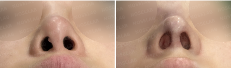 Before and immediately after surgery basal view showing improved nostril symmetry and stabilized nasal tip position following revision closed rhinoplasty with rib cartilage reconstruction.
