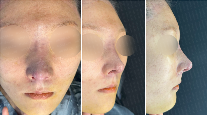 Photos taken immediately after surgery, frontal view, 45-angle view, and side profile.