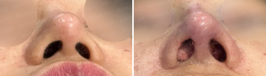 Nostril view before (left) and immediately after (right) nasal septum reconstruction surgery