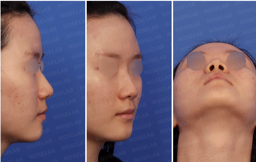 Preoperative design consultation images showing right lateral view, right oblique side view, and nostril view of a female patient with a wide nasal bridge and blunt nasal tip.