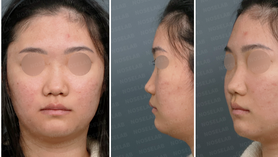 Preoperative design consultation photos showing frontal view, left oblique side view, and left side view of a patient with low nasal bridge and bulbous nasal tip before structural closed rhinoplasty.
