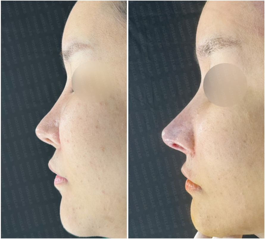 Before and immediately after autologous rib cartilage rhinoplasty revision in Korea – side view comparison showing lowered bridge starting point, refined nasal tip, and improved nasolabial angle.