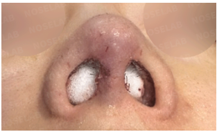 Immediately after emergency revision rhinoplasty: basal nostril view showing columella reconstruction, internal packing, and improved nostril symmetry.