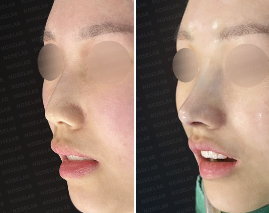 Before and immediately after surgery oblique view showing improved nasal bridge alignment and natural tip projection following implant-free closed rhinoplasty with rib cartilage reconstruction.