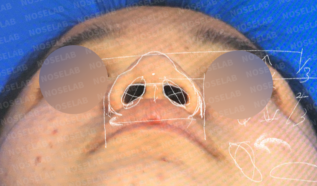Base view examination revealing nostril configuration before corrective nasal surgery