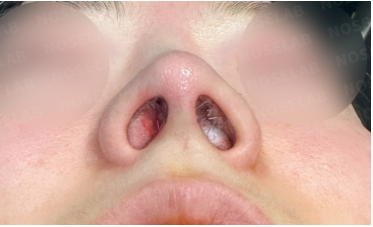 Immediate post-surgery nostril view after closed rhinoplasty for bulbous and upturned nose correction. Nostril symmetry and nasal base improvement are visible.
