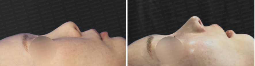 Revision rhinoplasty for short upturned nose – before and after side view photos