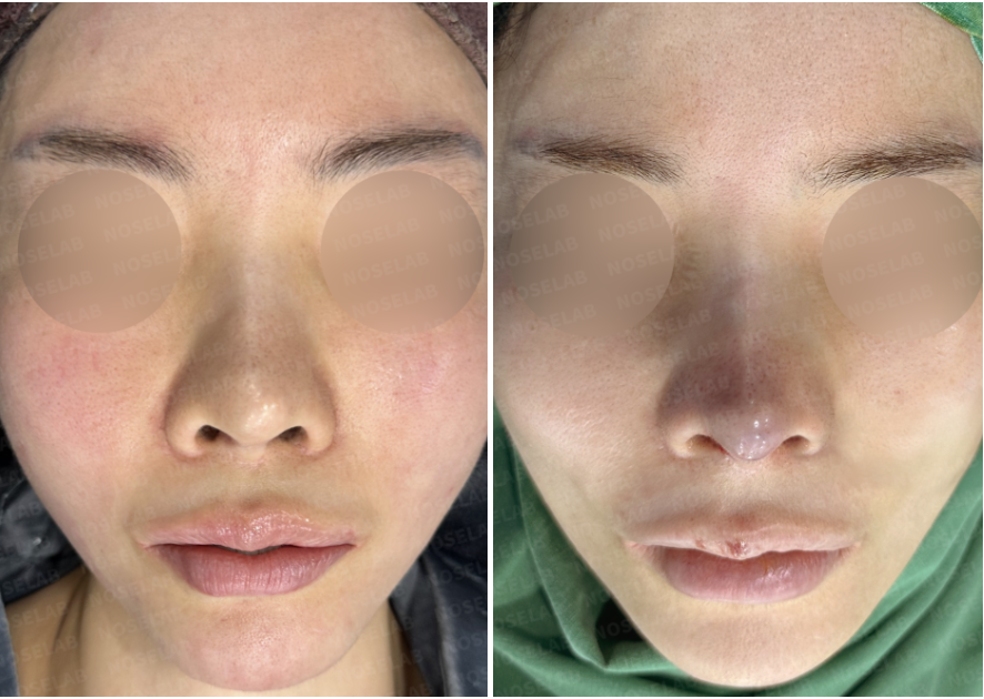Before and immediately after surgery frontal view showing improved nasal symmetry and restored structural support following closed revision rhinoplasty with autologous rib cartilage for severe nasal obstruction.