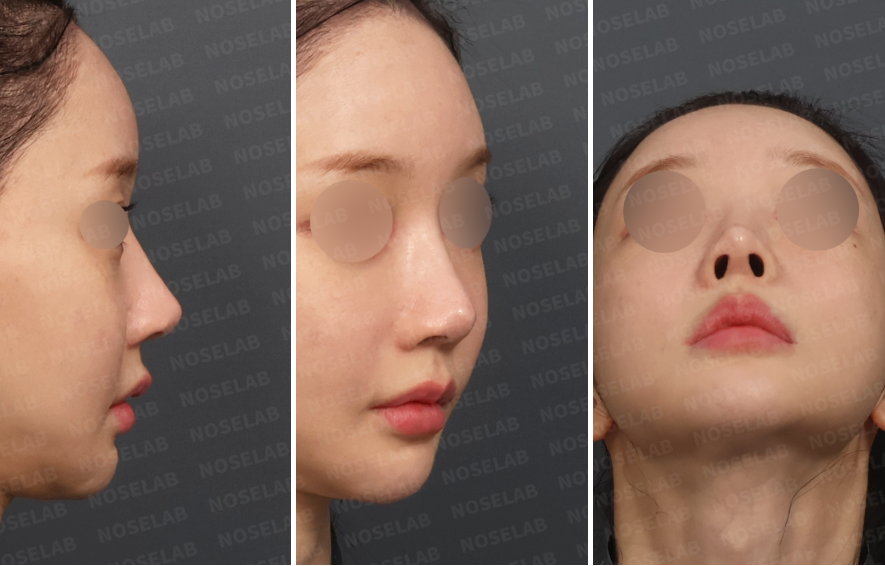 Preoperative design consultation photos showing low nasal bridge, under-projected nasal tip, nostril asymmetry, and insufficient nasal height from right lateral, right oblique, and basal views.