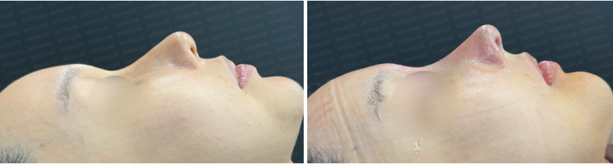 Rhinoplasty for long mid-face correction – before (left) and after (right) side view photos