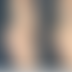 Before and after droopy nasal tip correction, lateral view showing improved nasolabial angle, lifted nasal tip, and refined natural contour.