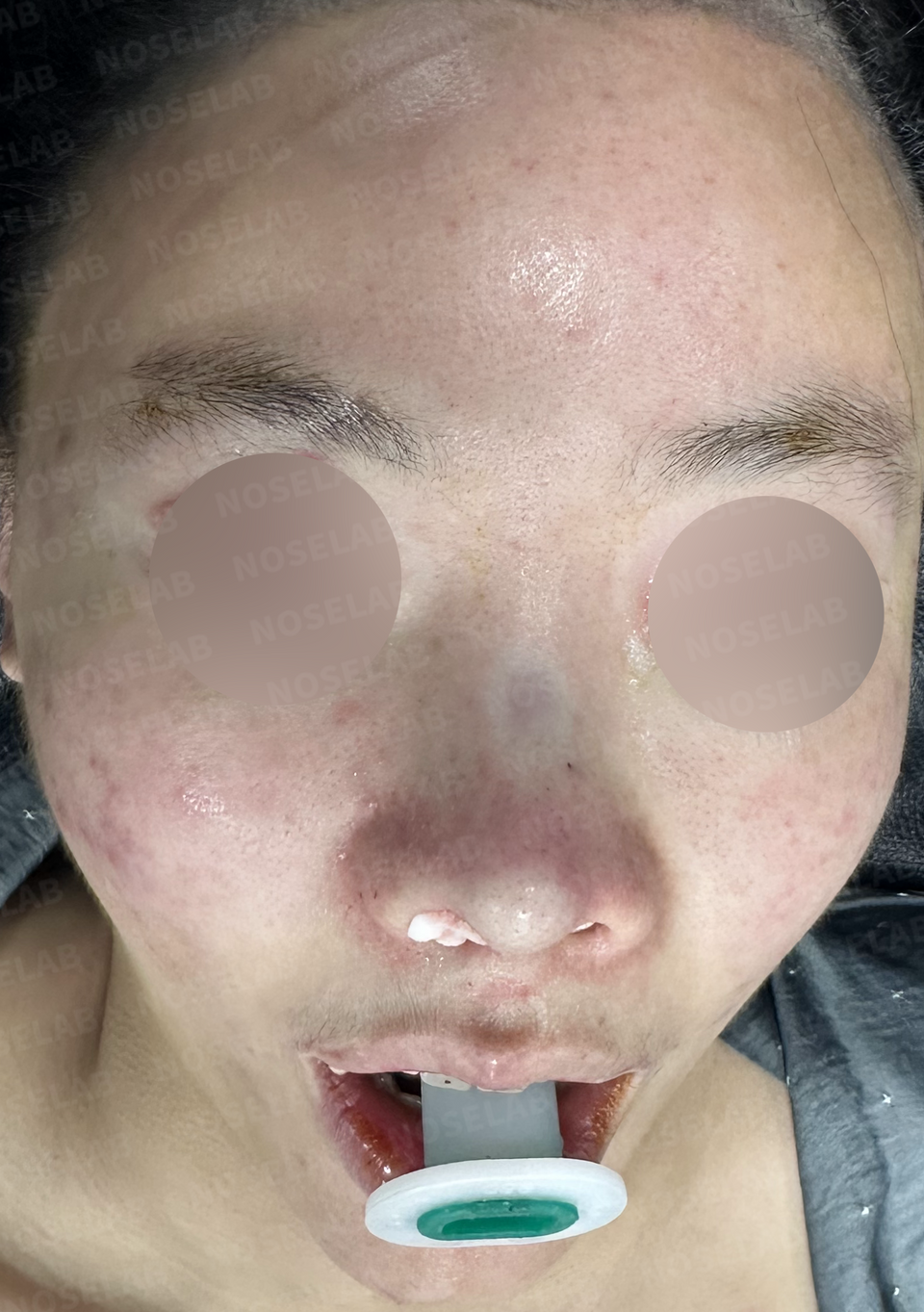 Immediately after surgery: frontal view.