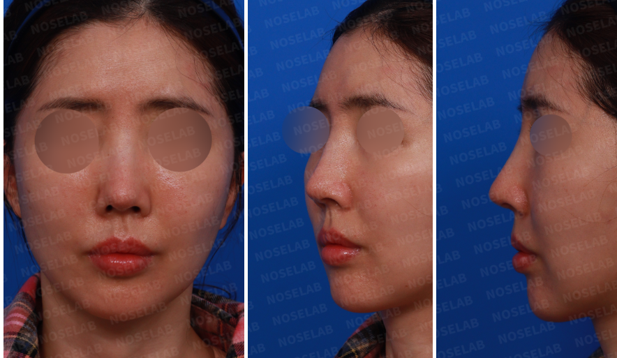 Preoperative design consultation photos showing frontal, left oblique, and side views of the patient before long nose correction rhinoplasty.