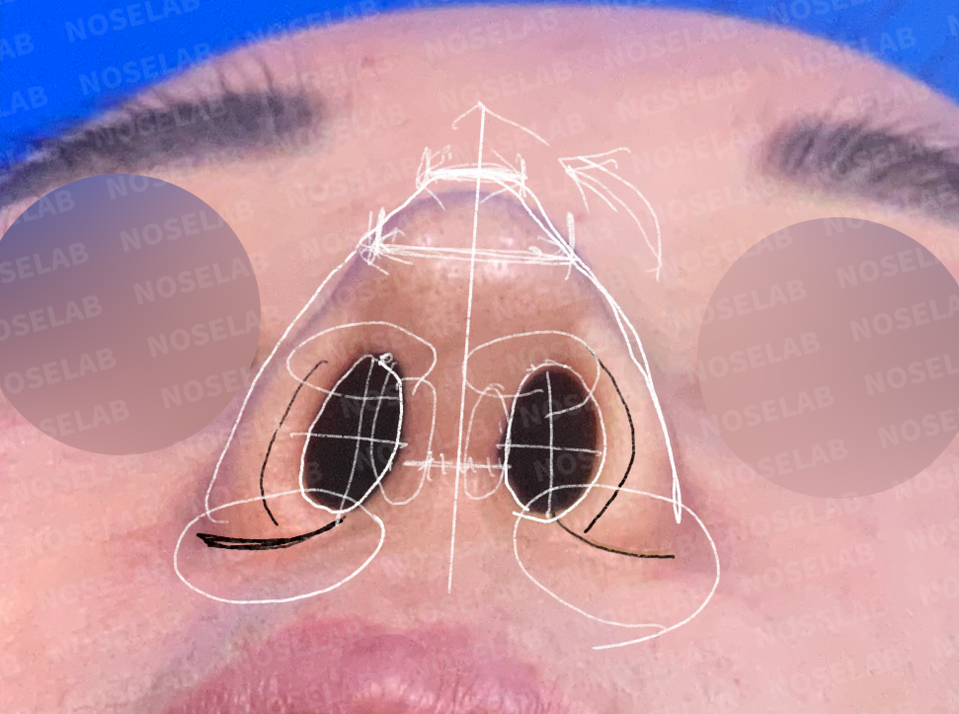 Preoperative nostril view showing asymmetry and retracted columella before Closed Rhinoplasty Korea – design markings for deviated nose and asymmetric nostril correction using self-rib cartilage.