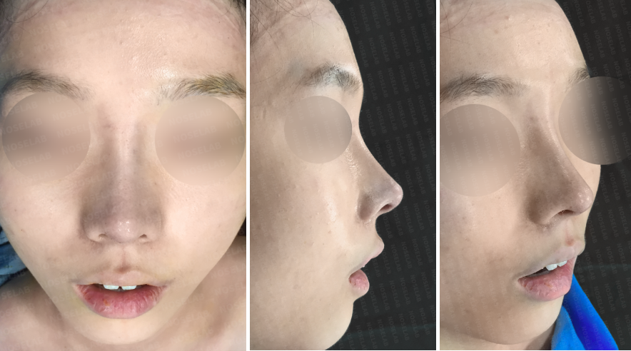 Short nose rhinoplasty – immediate postoperative photos showing frontal, side, and oblique 45-degree views