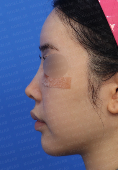 Pinched Nose corrective rhinoplasty – preoperative design consultation 45-degree view