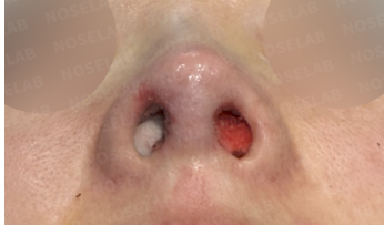 Immediately after long nose correction surgery: nostril view photo