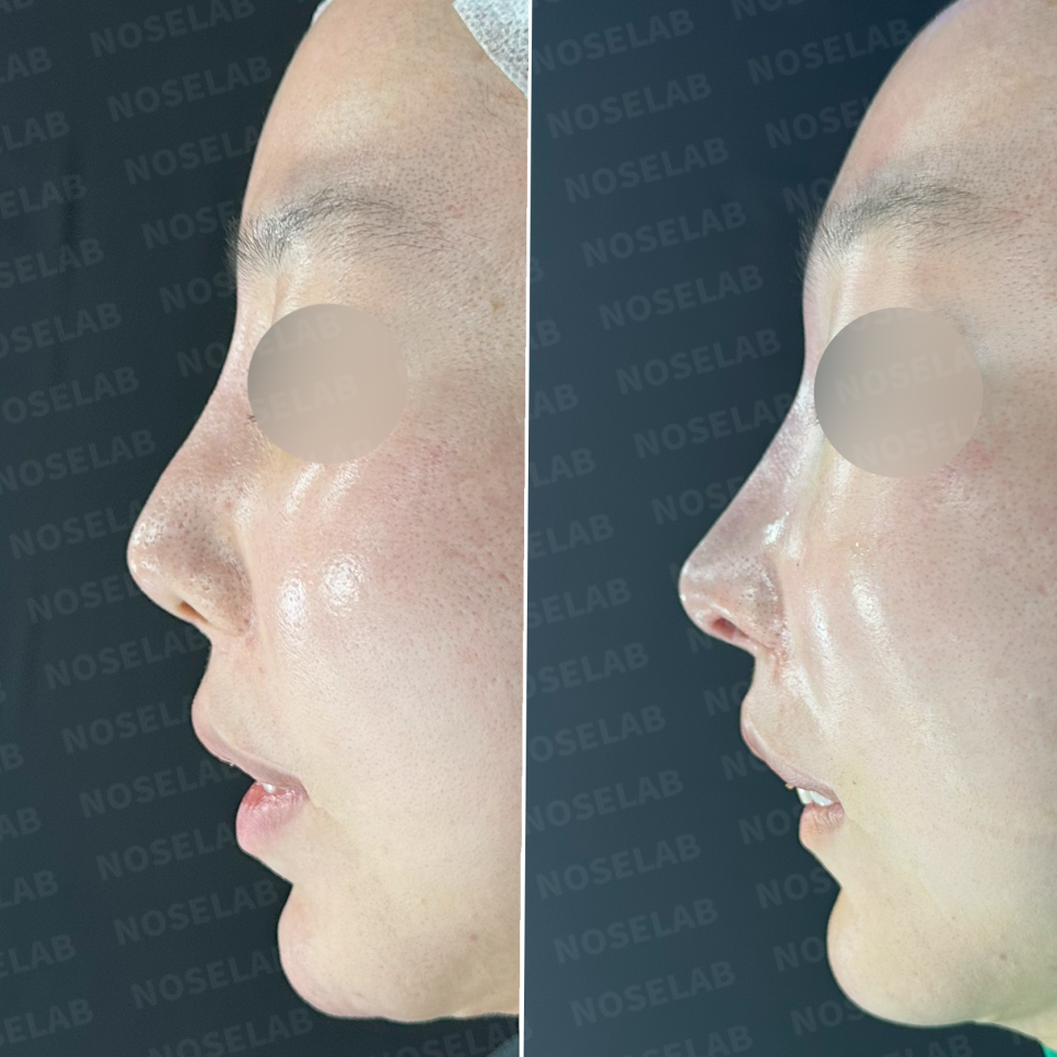 Side view comparison before and after closed rhinoplasty for columella retraction and upturned nose correction