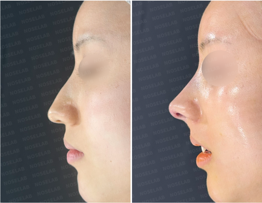 Before and immediately after hump nose correction – side profile view showing dorsal hump reduction, smoother nasal bridge, and improved nasal tip projection.