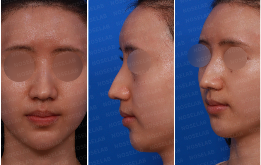 Frontal, left side, and oblique view before hump nose correction surgery – patient with long nose, dorsal hump, and wide nasal tip.