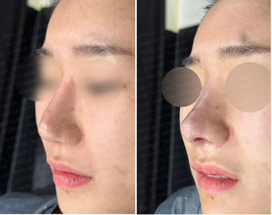 Before and immediately after revision rhinoplasty for correcting overly reduced alar base – oblique side view.