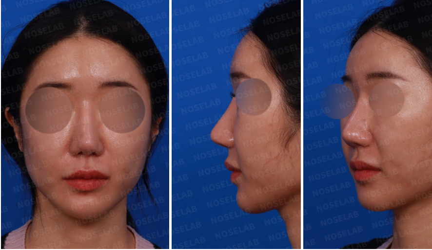 Before and after revision rhinoplasty for correcting overly reduced alar base – front, side, and oblique views of the patient.