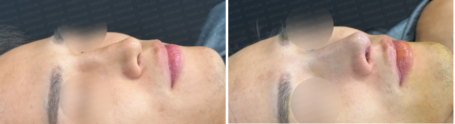 Before (left) and immediately after surgery (right) oblique side view photos of a male patient, showing correction of crooked nose and enhancement of nasal bridge projection.