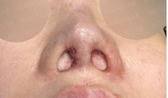 Immediately after revision rhinoplasty – nostril view showing surgical site and structural reconstruction."