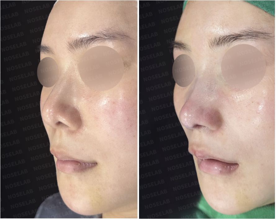 Oblique view before and immediately after no-implant revision rhinoplasty